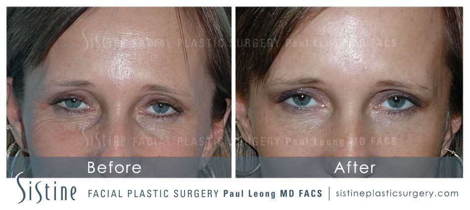 Dermal Fillers Before and After | Leong Facial Plastic Surgery