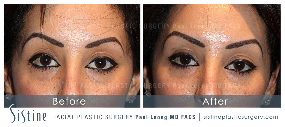 Dermal Fillers Before and After | Leong Facial Plastic Surgery