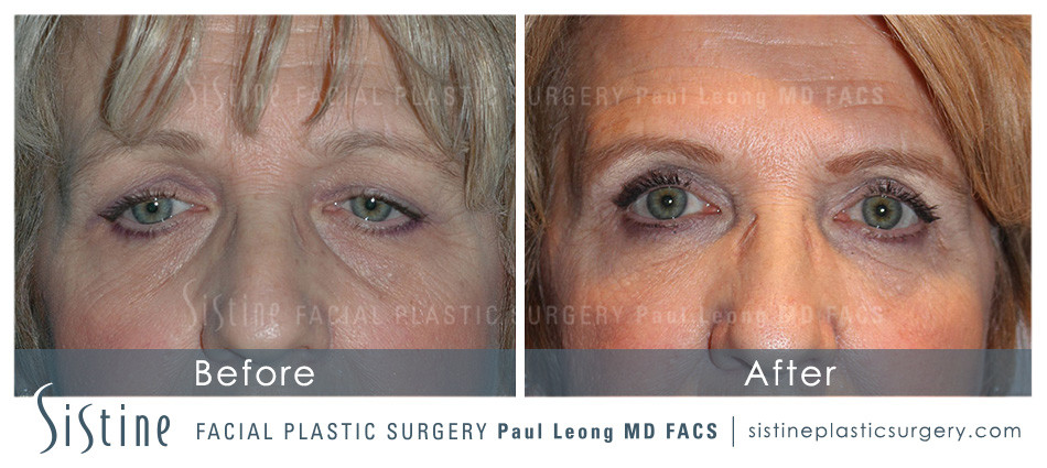 Dermal Fillers Before and After | Leong Facial Plastic Surgery