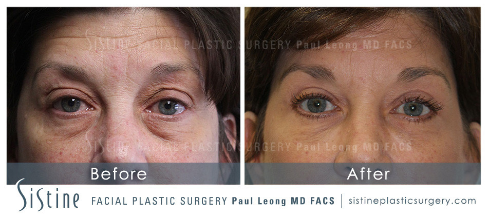 Dermal Fillers Before and After | Leong Facial Plastic Surgery