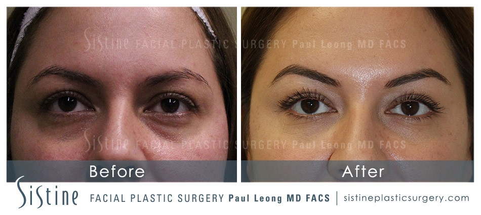 Dermal Fillers Before and After | Leong Facial Plastic Surgery