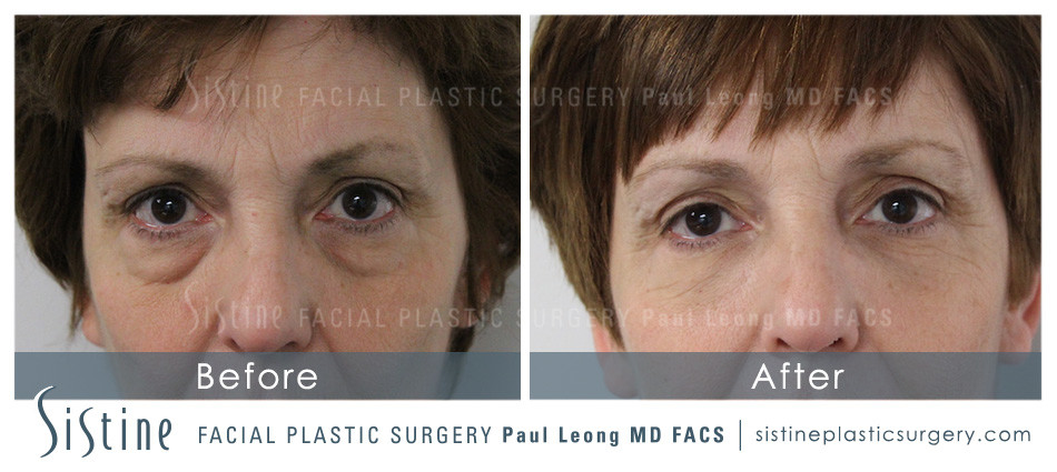 Dermal Fillers Before and After | Leong Facial Plastic Surgery