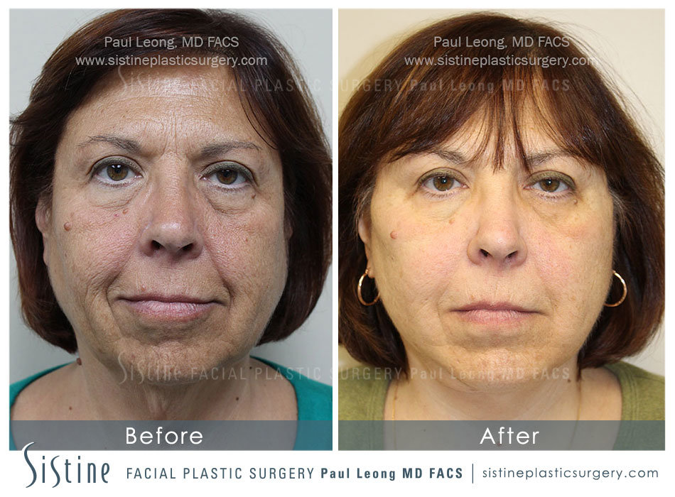 Dermal Fillers Before and After | Leong Facial Plastic Surgery