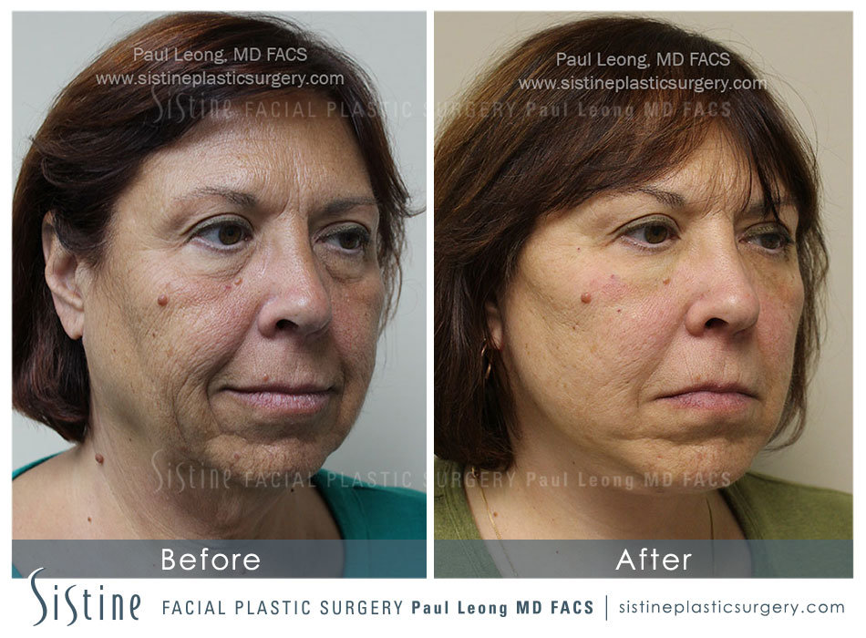 Dermal Fillers Before and After | Leong Facial Plastic Surgery