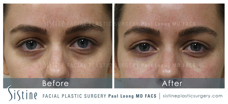 Dermal Fillers Before and After | Leong Facial Plastic Surgery