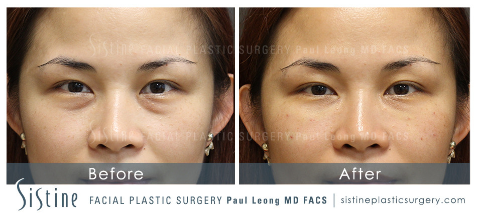 Dermal Fillers Before and After | Leong Facial Plastic Surgery