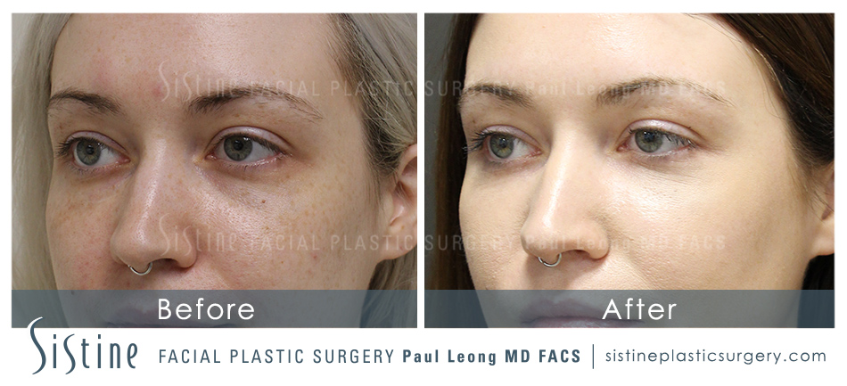 Dermal Fillers Before and After | Leong Facial Plastic Surgery