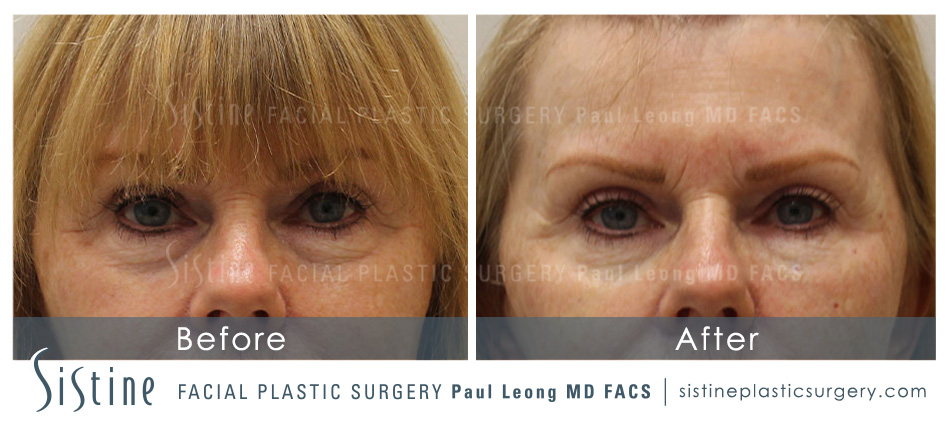 Dermal Fillers Before and After | Leong Facial Plastic Surgery