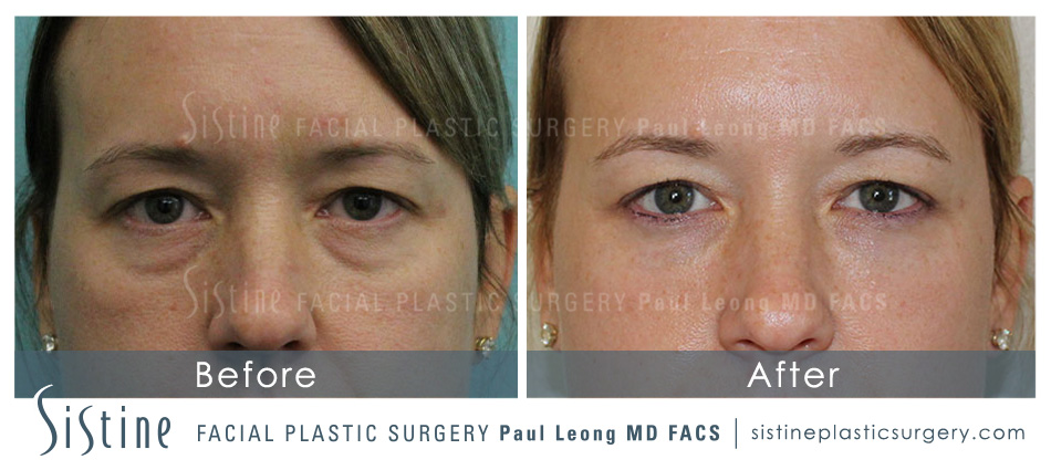 Dermal Fillers Before and After | Leong Facial Plastic Surgery