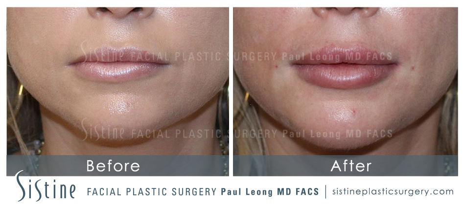 Dermal Fillers Before and After | Leong Facial Plastic Surgery