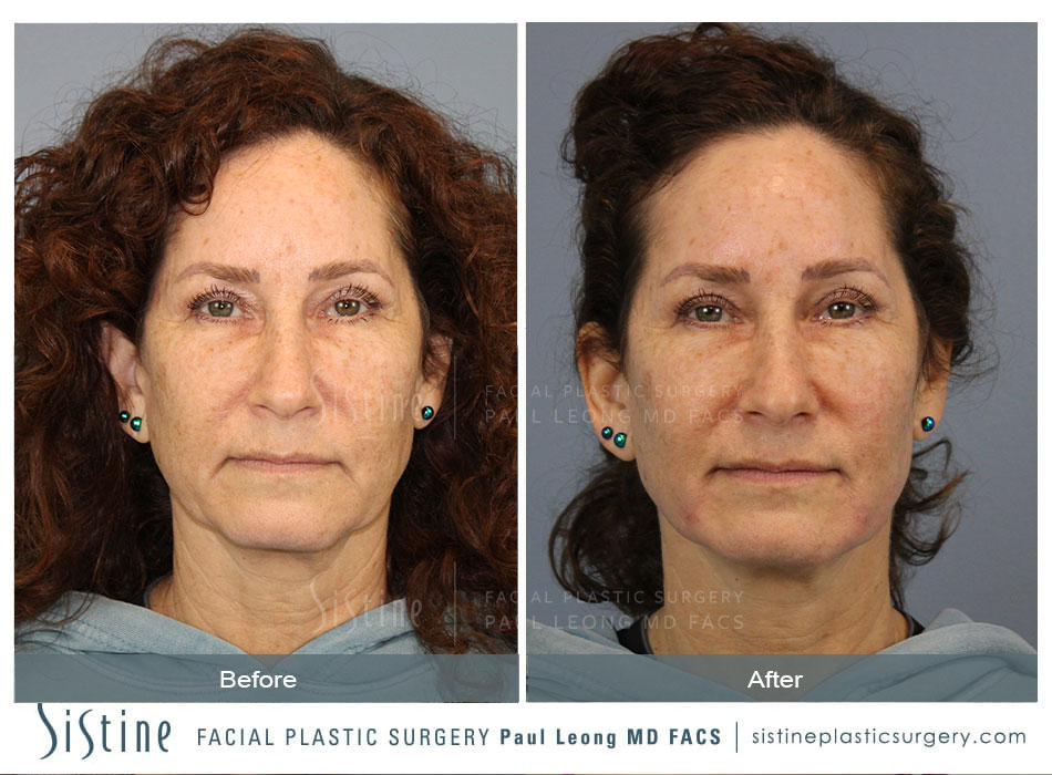 Dermal Fillers Before and After | Leong Facial Plastic Surgery