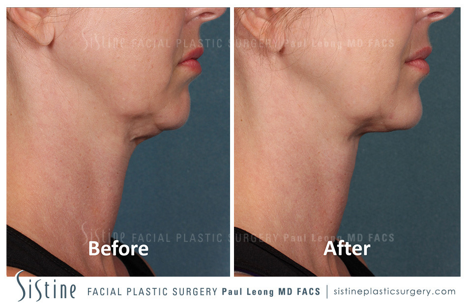 Kybella Before and After | Leong Facial Plastic Surgery