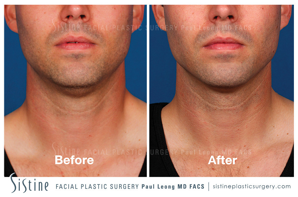 Kybella Before and After | Leong Facial Plastic Surgery