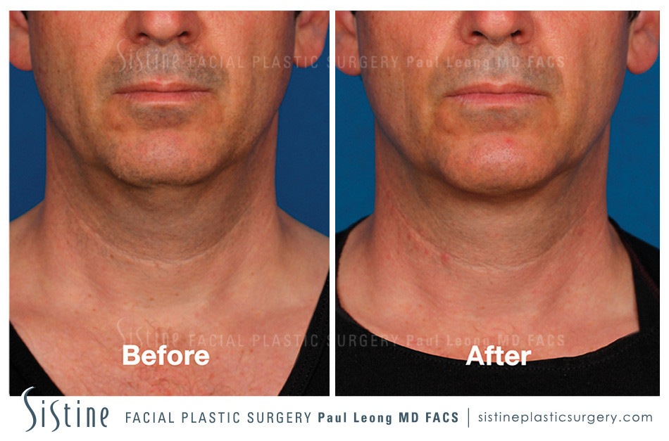 Kybella Before and After | Leong Facial Plastic Surgery