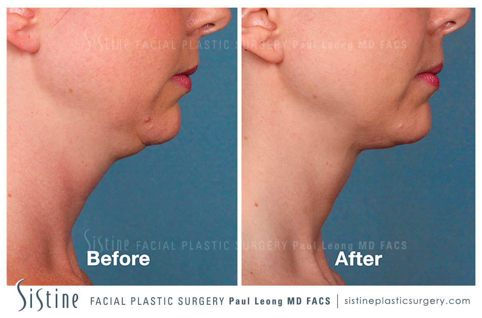 Kybella Before and After | Leong Facial Plastic Surgery