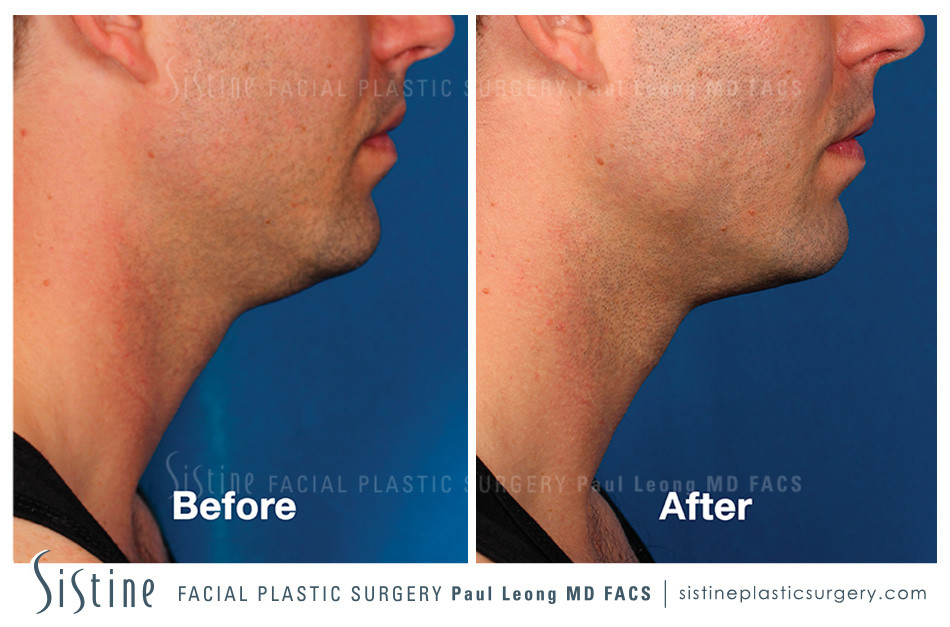 Kybella Before and After | Leong Facial Plastic Surgery