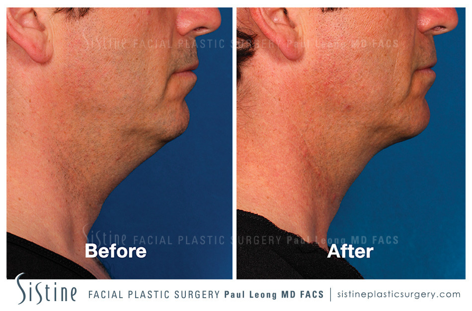 Kybella Before and After | Leong Facial Plastic Surgery