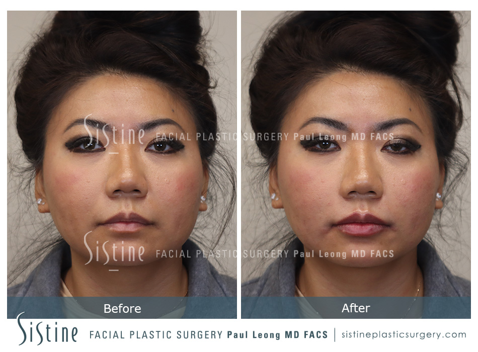 Lip Augmentation Before and After | Leong Facial Plastic Surgery