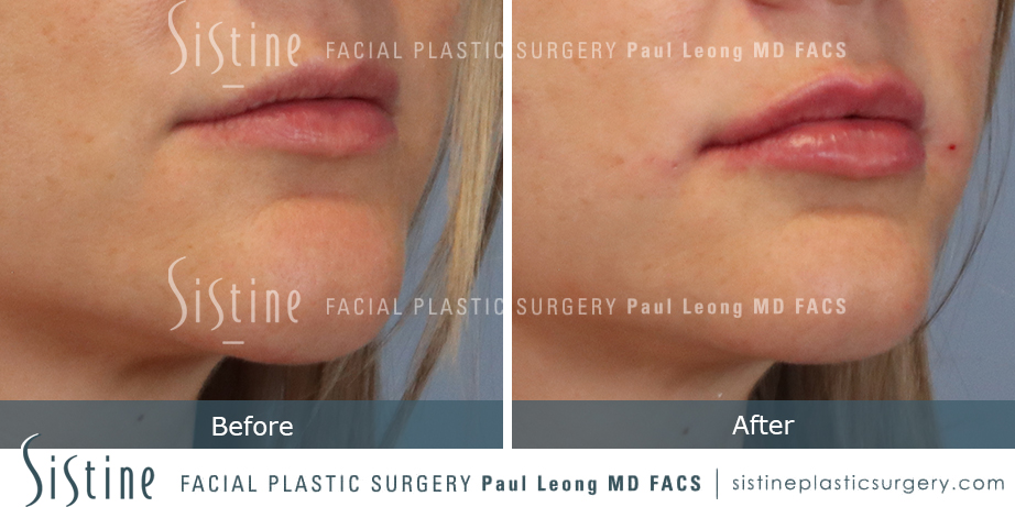 Lip Augmentation Before and After | Leong Facial Plastic Surgery