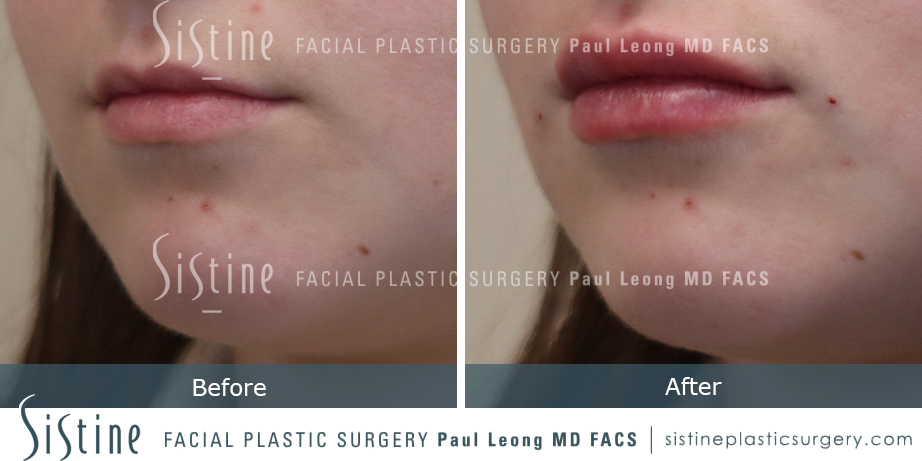 Lip Augmentation Before and After | Leong Facial Plastic Surgery