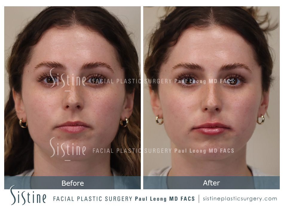 Lip Augmentation Before and After | Leong Facial Plastic Surgery