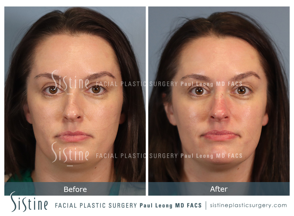 Non Surgical Rhinoplasty Before and After | Leong Facial Plastic Surgery