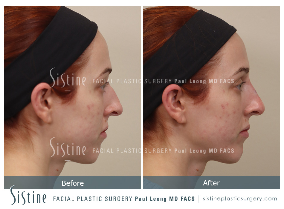 Non Surgical Rhinoplasty Before and After | Leong Facial Plastic Surgery