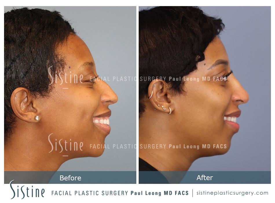 Non Surgical Rhinoplasty Before and After | Leong Facial Plastic Surgery