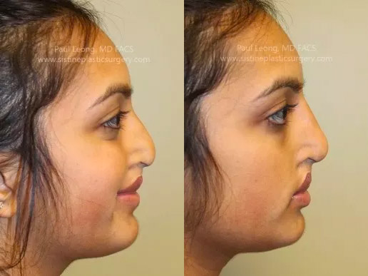 Non Surgical Rhinoplasty Before and After | Leong Facial Plastic Surgery