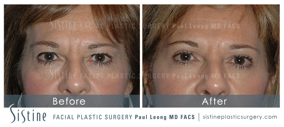 Restylane Juvederm Before and After | Leong Facial Plastic Surgery