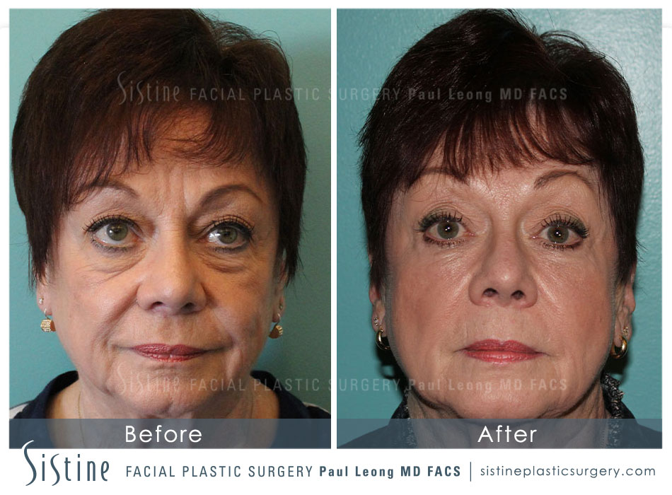 Restylane Juvederm Before and After | Leong Facial Plastic Surgery