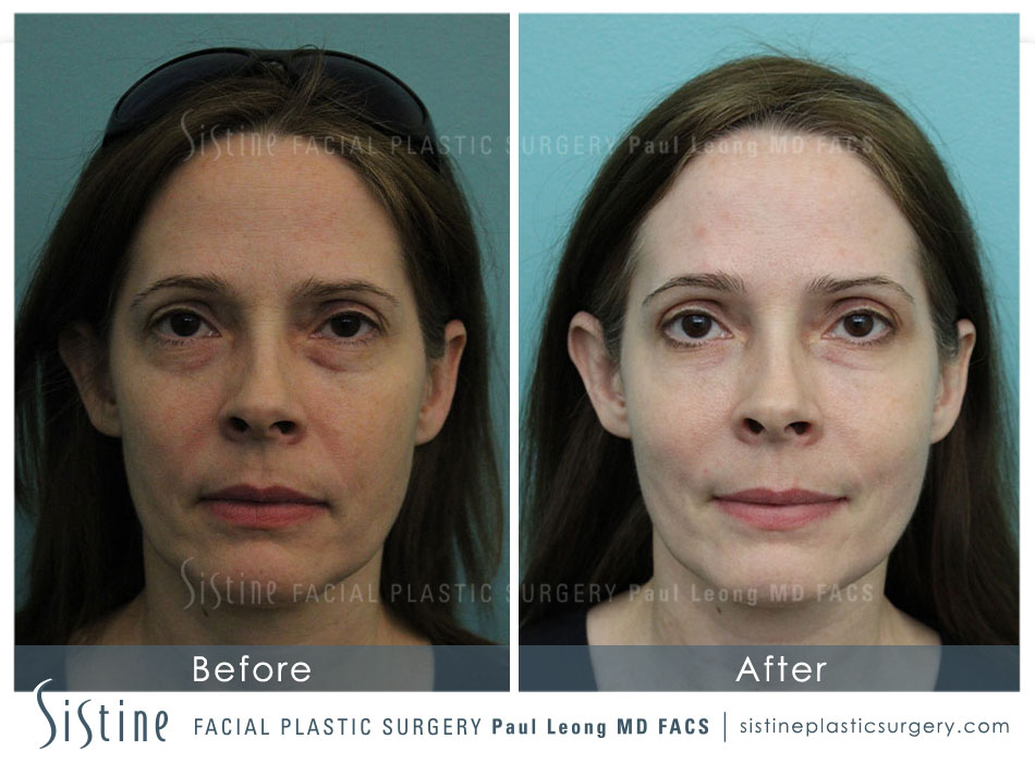 Restylane Juvederm Before and After | Leong Facial Plastic Surgery