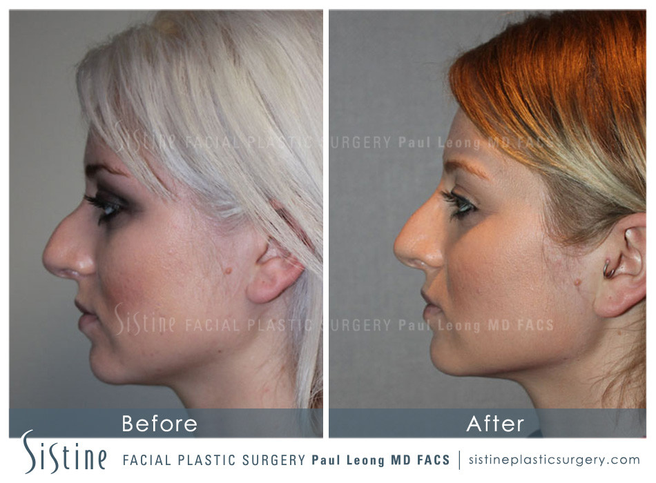 Restylane Juvederm Before and After | Leong Facial Plastic Surgery