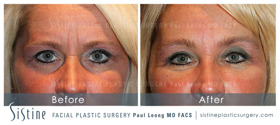 Restylane Juvederm Before and After | Leong Facial Plastic Surgery