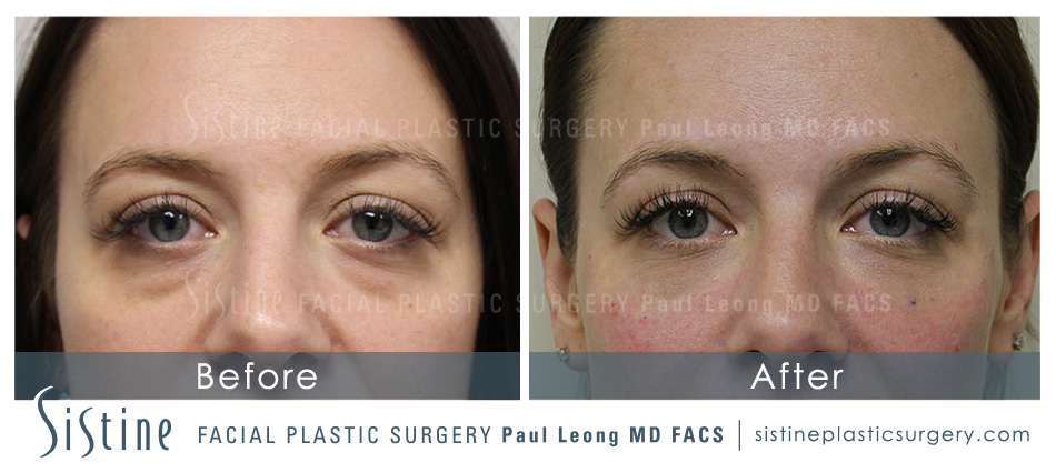 Restylane Juvederm Before and After | Leong Facial Plastic Surgery