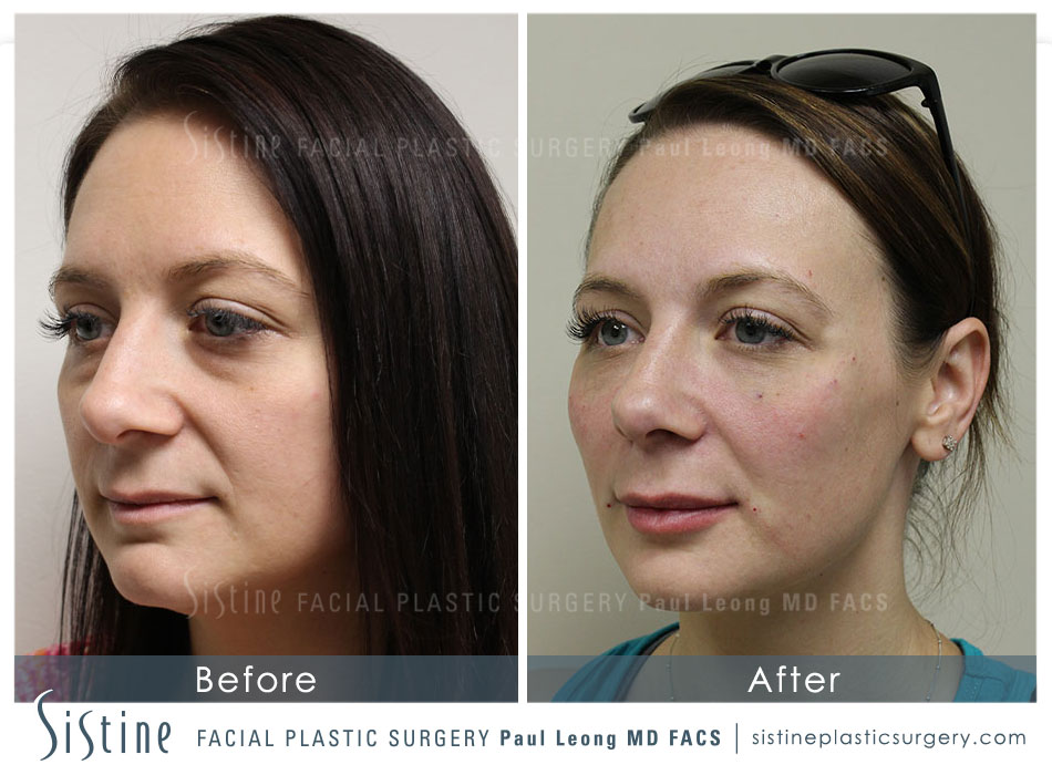 Restylane Juvederm Before and After | Leong Facial Plastic Surgery