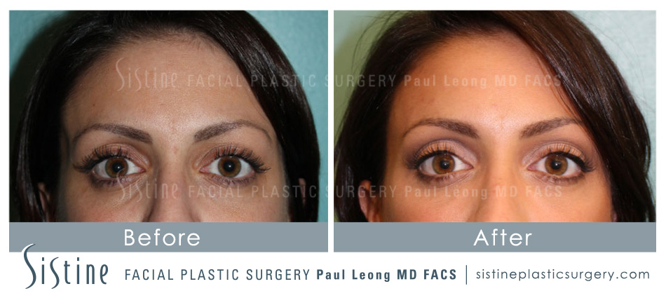 Restylane Juvederm Before and After | Leong Facial Plastic Surgery