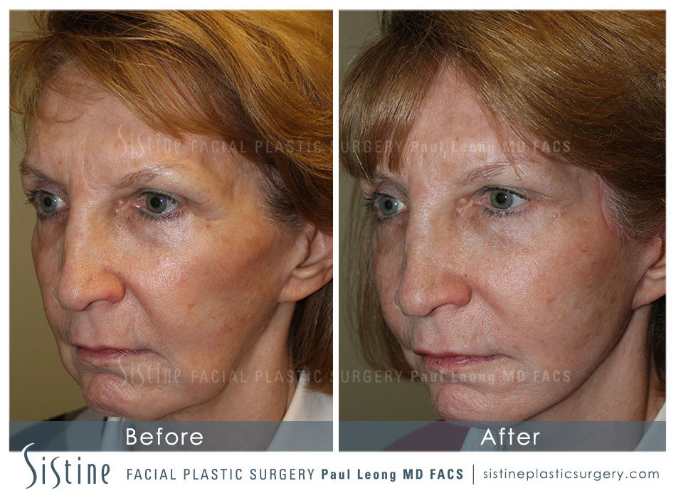 Sculptra Before and After | Leong Facial Plastic Surgery