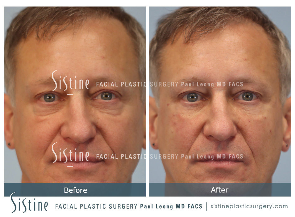 Tear Trough Correction Before and After | Leong Facial Plastic Surgery