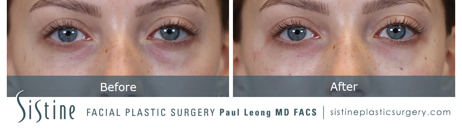 Tear Trough Correction Before and After | Leong Facial Plastic Surgery