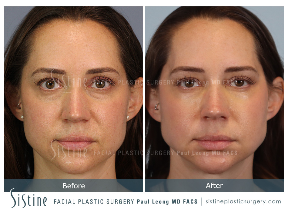 Tear Trough Correction Before and After | Leong Facial Plastic Surgery