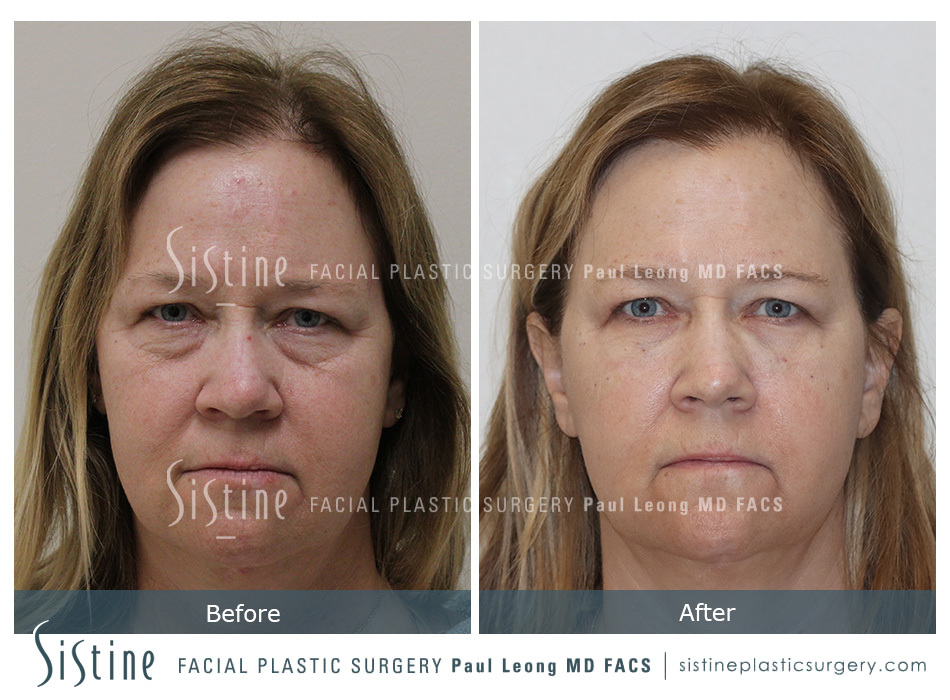 Tear Trough Correction Before and After | Leong Facial Plastic Surgery