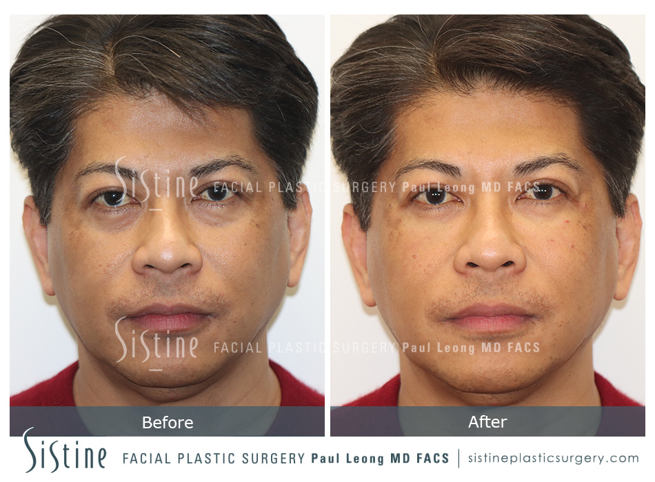 Tear Trough Correction Before and After | Leong Facial Plastic Surgery