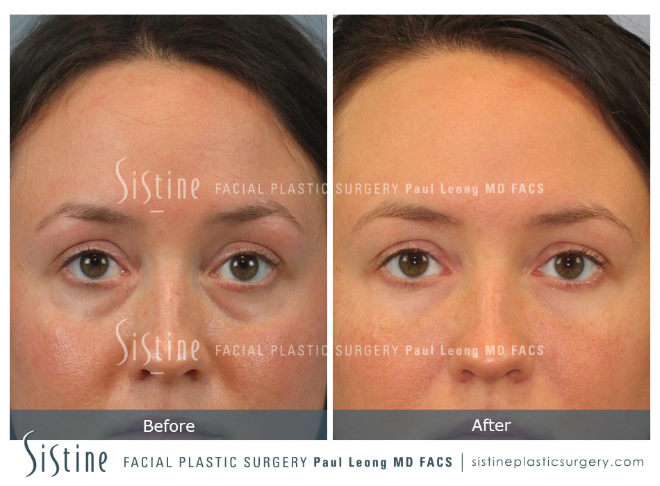 Tear Trough Correction Before and After | Leong Facial Plastic Surgery