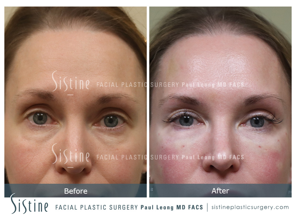 Tear Trough Correction Before and After | Leong Facial Plastic Surgery