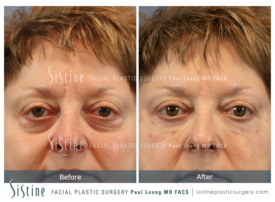 Tear Trough Correction Before and After | Leong Facial Plastic Surgery