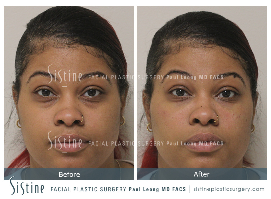 Tear Trough Correction Before and After | Leong Facial Plastic Surgery