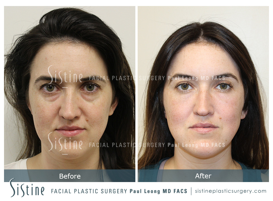 Tear Trough Correction Before and After | Leong Facial Plastic Surgery