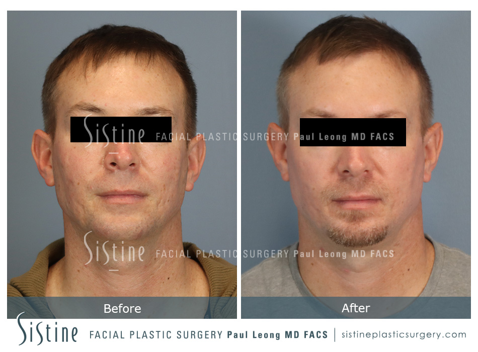 Phoenix Co2 Before and After | Leong Facial Plastic Surgery