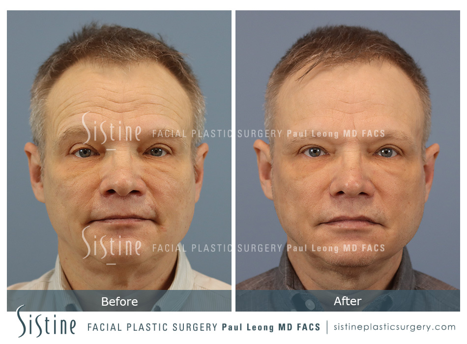 Phoenix Co2 Before and After | Leong Facial Plastic Surgery